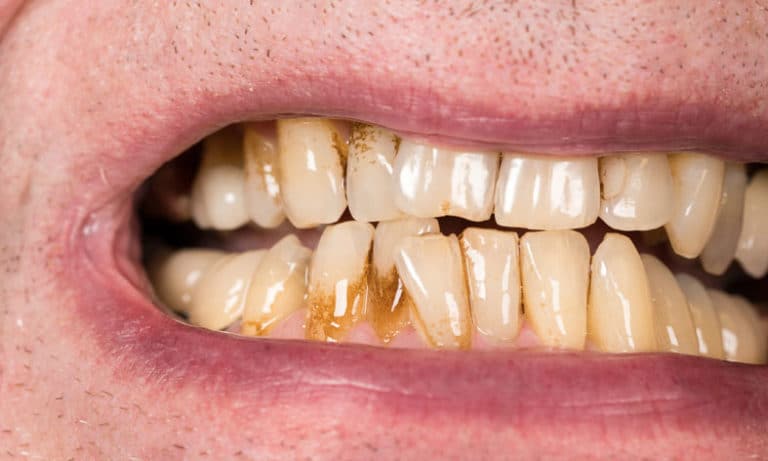 Everything you need to know about receding gums