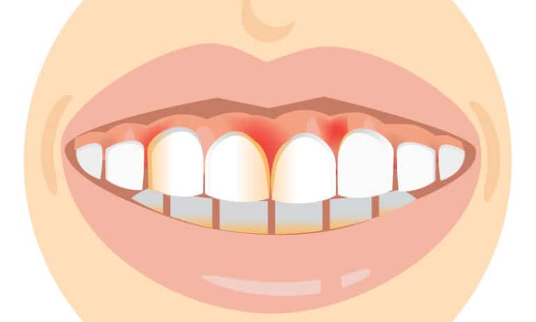 Swollen Gums: Possible Causes and Treatments