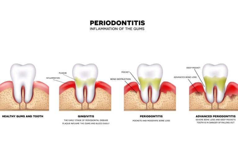 Gingivitis and Periodontal Disease – What is it?