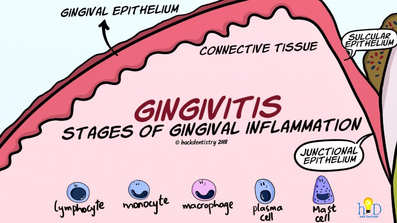 Stages of Gingival Inflammation